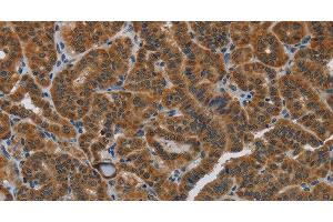 Immunohistochemistry of paraffin-embedded Human thyroid cancer using HSD3B7 Polyclonal Antibody at dilution of 1:40 (HSD3B7 抗体)