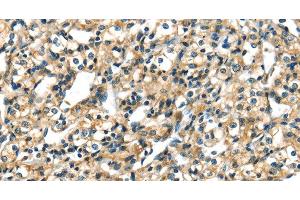 Immunohistochemistry of paraffin-embedded Human prostate cancer tissue using CK-17 Polyclonal Antibody at dilution 1:40 (KRT17 抗体)