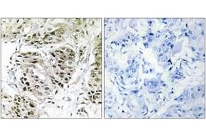 Immunohistochemistry analysis of paraffin-embedded human breast carcinoma, using CENPA Antibody. (CENPA 抗体  (AA 11-60))
