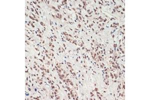 Immunohistochemistry of paraffin-embedded human gastric cancer using TDP-43/TARDB antibody (ABIN7270731) at dilution of 1:200 (40x lens).
