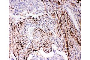 Anti-ADAM19 antibody, IHC(P) IHC(P): Human Lung Cancer Tissue (ADAM19 抗体  (N-Term))