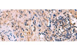 Immunohistochemistry of paraffin-embedded Human cervical cancer tissue using KCNIP1 Polyclonal Antibody at dilution of 1:60(x200) (KCNIP1 抗体)