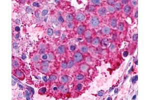 Anti-GPR116 antibody IHC of human Breast, Carcinoma. (G Protein-Coupled Receptor 116 抗体  (N-Term))