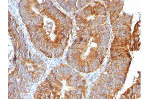 Formalin-fixed, paraffin-embedded human Colon Carcinoma stained with VEGI Rabbit Recombinant Monoclonal Antibody (VEGI /2052R). (Recombinant TNFSF15 抗体)