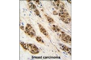 Formalin-fixed and raffin-embedded human breast carcinoma tissue reacted with XTP3T antibody (N-term), which was peroxidase-conjugated to the secondary antibody, followed by DAB staining. (DCTPP1 抗体  (N-Term))