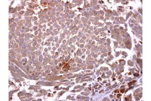 IHC-P Image Glycophorin A antibody [C1C3] detects Glycophorin A protein at cytosol on human lung carcinoma by immunohistochemical analysis. (CD235a/GYPA 抗体  (C-Term))