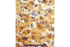 Formalin-fixed and paraffin-embedded human hepatocarcinoma reacted with RPS15 Antibody (N-term), which was peroxidase-conjugated to the secondary antibody, followed by DAB staining. (RPS15 抗体  (N-Term))