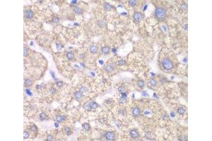 Immunohistochemistry of paraffin-embedded Human liver damage using ACAT1 Polyclonal Antibody at dilution of 1:100 (40x lens). (ACAT1 抗体)