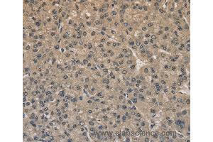 Immunohistochemistry of Human liver cancer using DRG1 Polyclonal Antibody at dilution of 1:20 (DRG1 抗体)