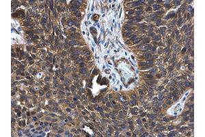 IHC-P Image FGD4 antibody [N1N3] detects FGD4 protein at cytoplasm in human lung cancer by immunohistochemical analysis. (FGD4 抗体)