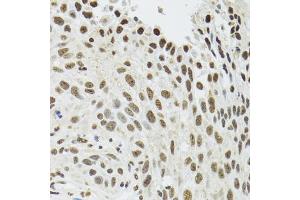 Immunohistochemistry of paraffin-embedded human lung cancer using SFPQ antibody. (SFPQ 抗体)