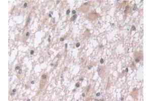 Detection of PSMa5 in Human Glioma Tissue using Polyclonal Antibody to Proteasome Subunit Alpha Type 5 (PSMa5) (PSMA5 抗体  (AA 1-241))