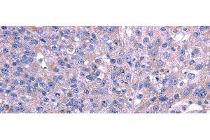 Immunohistochemistry of paraffin-embedded Human breast cancer using TRIM49 Polyclonal Antibody at dilution of 1/40 (TRIM49 抗体)