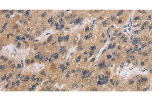 Immunohistochemistry of paraffin-embedded Human liver cancer tissue using CST6 Polyclonal Antibody at dilution 1:30 (CST6 抗体)