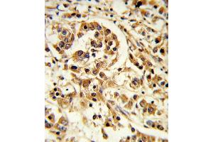 Formalin-fixed and paraffin-embedded human breast carcinoma reacted with IL12A Antibody (C-term), which was peroxidase-conjugated to the secondary antibody, followed by DAB staining. (IL12A 抗体  (C-Term))