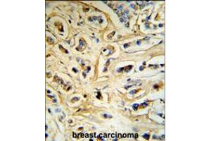 CASA Antibody (RB18742) IHC analysis in formalin fixed and paraffin embedded human breast carcinoma tissue followed by peroxidase conjugation of the secondary antibody and DAB staining. (Casein alpha S1 抗体  (AA 42-70))
