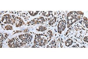 Immunohistochemistry of paraffin-embedded Human esophagus cancer tissue using ATAD1 Polyclonal Antibody at dilution of 1:65(x200) (ATAD1 抗体)