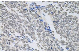 Immunohistochemistry of paraffin-embedded Human lung cancer using PAX3 Polyclonal Antibody at dilution of 1:100 (40x lens). (Paired Box 3 抗体)