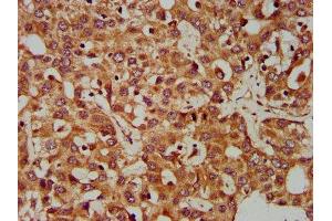 IHC image of ABIN7147569 diluted at 1:400 and staining in paraffin-embedded human liver cancer performed on a Leica BondTM system. (CLCC1 抗体  (AA 446-551))