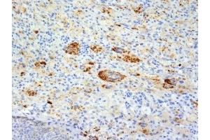 Formalin-fixed, paraffin-embedded human Erdheim Chester disease (also known as polyostotic lerosing histiocytosis) stained with TNF alpha antibody (TNFA/1172). (TNF alpha 抗体)