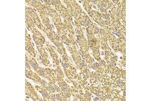 Immunohistochemistry of paraffin-embedded Human liver injury using ATP5B antibody at dilution of 1:100 (x400 lens). (ATP5B 抗体)