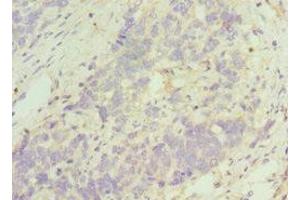 Immunohistochemistry of paraffin-embedded human endometrial cancer using ABIN7161335 at dilution of 1:100 (TACR3 抗体  (AA 356-465))
