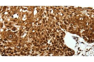 Immunohistochemistry of paraffin-embedded Human cervical cancer tissue using SCN1A Polyclonal Antibody at dilution 1:40 (SCN1A 抗体)