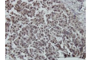 Immunoperoxidase of monoclonal antibody to FOXO3A on formalin-fixed paraffin-embedded human breast cancer. (FOXO3 抗体  (AA 361-460))
