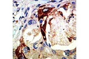 IHC analysis of FFPE human breast carcinoma tissue stained with the Myb antibody (MYB 抗体  (AA 506-534))