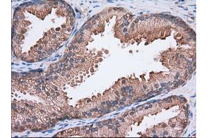 Immunohistochemical staining of paraffin-embedded Adenocarcinoma of Human colon tissue using anti-SNX9 mouse monoclonal antibody. (SNX9 抗体)