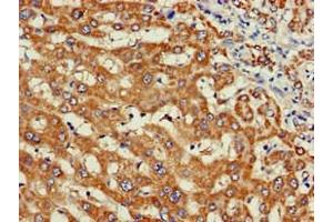 Immunohistochemistry of paraffin-embedded human liver cancer using ABIN7175855 at dilution of 1:100 (WISP3 抗体  (AA 201-372))