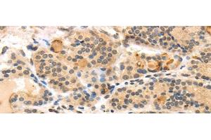 Immunohistochemistry of paraffin-embedded Human thyroid cancer using TUSC5 Polyclonal Antibody at dilution of 1/40 (TUSC5 抗体)