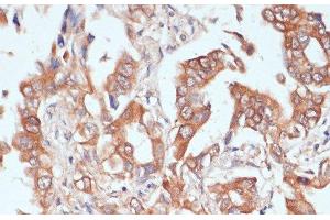 Immunohistochemistry of paraffin-embedded Human lung cancer using PTPRN2 Polyclonal Antibody at dilution of 1:100 (40x lens). (PTPRN2 抗体)