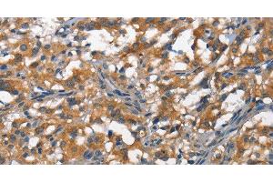 Immunohistochemistry of paraffin-embedded Human thyroid cancer tissue using DDR2 Polyclonal Antibody at dilution 1:40 (DDR2 抗体)