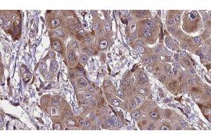 ABIN6276598 at 1/100 staining Human liver cancer tissue by IHC-P. (FCGR1A 抗体  (Internal Region))