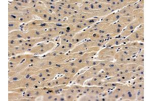 ABIN6259600 and ABIN6275767 at 1/100 staining human liver cancer by IHC-P. (HBAP1 抗体  (Internal Region))