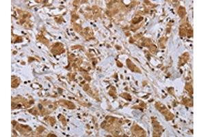 The image on the left is immunohistochemistry of paraffin-embedded Human breast cancer tissue using ABIN7191695(NPR2 Antibody) at dilution 1/45, on the right is treated with synthetic peptide. (NPR2 抗体)