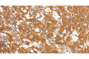 Immunohistochemistry of paraffin-embedded Human thyroid cancer using WNT3A Polyclonal Antibody at dilution of 1:40 (WNT3A 抗体)