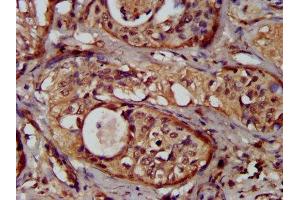 IHC image of ABIN7162085 diluted at 1:300 and staining in paraffin-embedded human cervical cancer performed on a Leica BondTM system.