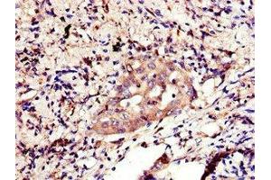 Immunohistochemistry of paraffin-embedded human lung cancer using ABIN7155812 at dilution of 1:100 (Nanog 抗体  (AA 1-305))