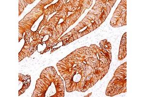 IHC testing of human colon carcinoma stained with Cytokeratin 8 antibody (K8/383). (KRT8 抗体)