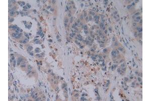 Detection of GZMB in Human Breast cancer Tissue using Polyclonal Antibody to Granzyme B (GZMB)