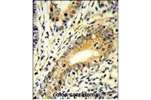 Formalin-fixed and paraffin-embedded human colon carcinoma reacted with FB Antibody (N-term), which was peroxidase-conjugated to the secondary antibody, followed by DAB staining. (FAM3B 抗体  (N-Term))