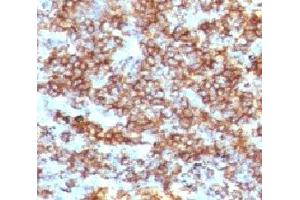 IHC testing of CD45RB antibody and FFPE human lymphoma (clone CDLA45RB-1). (CD45RB 抗体)