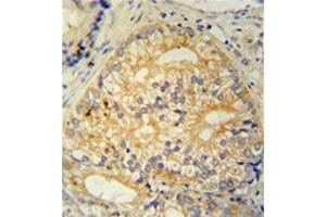 Formalin fixed and paraffin embedded human prostate carcinoma stained with CP013 Antibody (N-term) followed by peroxidase conjugation of the secondary antibody and DAB staining. (C16ORF13 抗体  (N-Term))