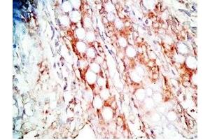 Human colon cancer tissue was stained by Rabbit Anti-Gastrin Releasing Peptide (Porcine) Antibody (Gastrin-Releasing Peptide 抗体)
