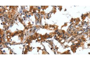Immunohistochemistry of paraffin-embedded Human thyroid cancer tissue using DEFA4 Polyclonal Antibody at dilution 1:40