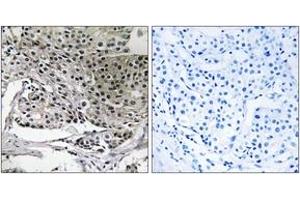 Immunohistochemistry analysis of paraffin-embedded human breast carcinoma tissue, using PIGY Antibody. (PIGY 抗体  (AA 3-52))