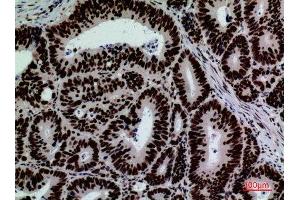 Immunohistochemistry (IHC) analysis of paraffin-embedded Human Colon Cancer, antibody was diluted at 1:100.