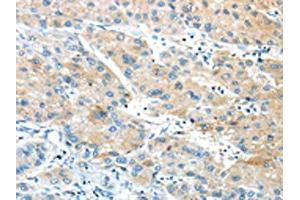 The image on the left is immunohistochemistry of paraffin-embedded Human liver cancer tissue using ABIN7190846(GPR15 Antibody) at dilution 1/20, on the right is treated with synthetic peptide. (GPR15 抗体)